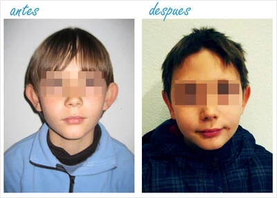 Clínica Estropá Otoplastia